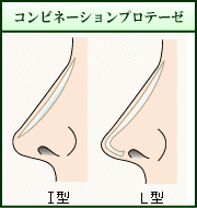 コンビネーションプロテーゼ（イメージ）