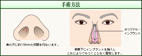 手術方法（イメージ）