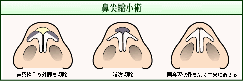 鼻尖縮小術（イメージ）
